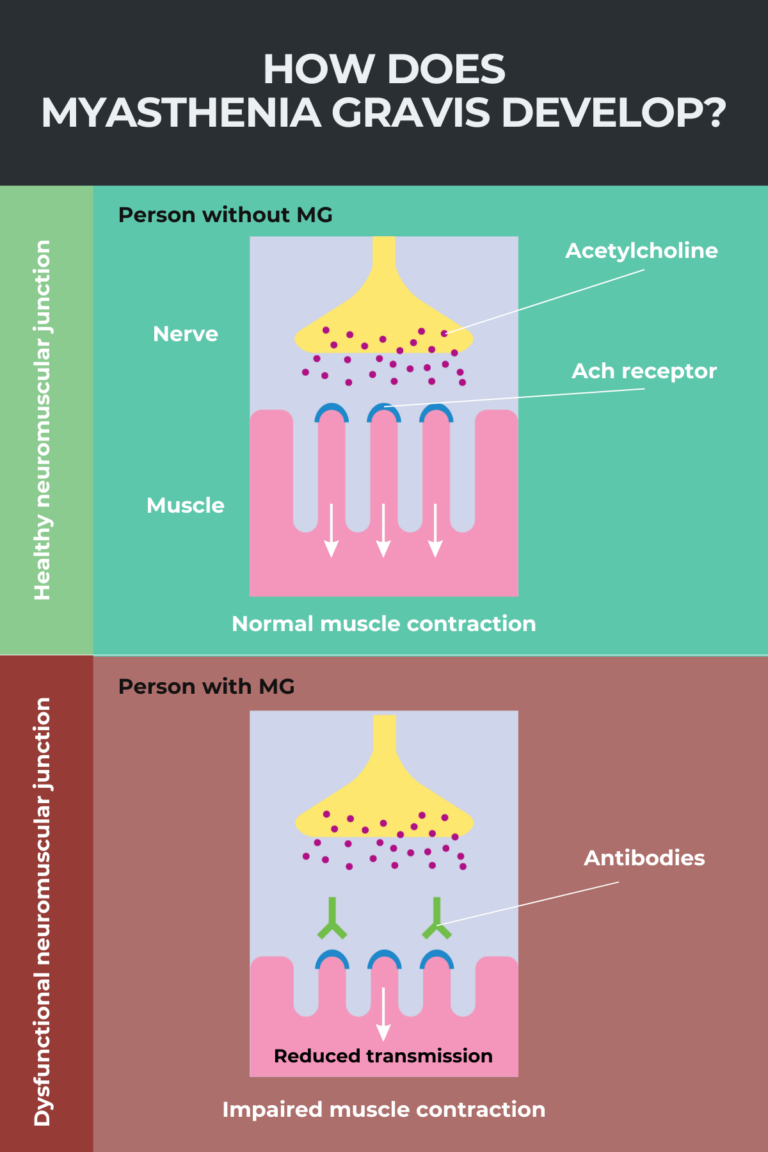 Myasthenia Gravis Everything You Need To Know Myasthenia Gravis News