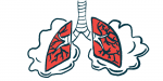 Thymus surgery | Myasthenia Gravis News | image of lungs
