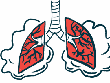 myasthenia gravis thymectomy | Myasthenia Gravis News | image of lungs