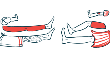 ocular myasthenia gravis | Myasthenia Gravis News | illustration of legs