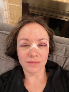A close-up photo of a woman whose eyes are puffy and nearly closed. She has medical tape on the bridge of her nose and at the sides of her eyes, indicating that she's recently had eye surgery. She's sitting on the couch in a living room. 