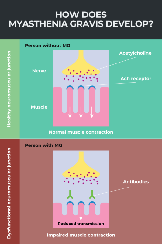 Infographic showing how myasthenia gravis develops