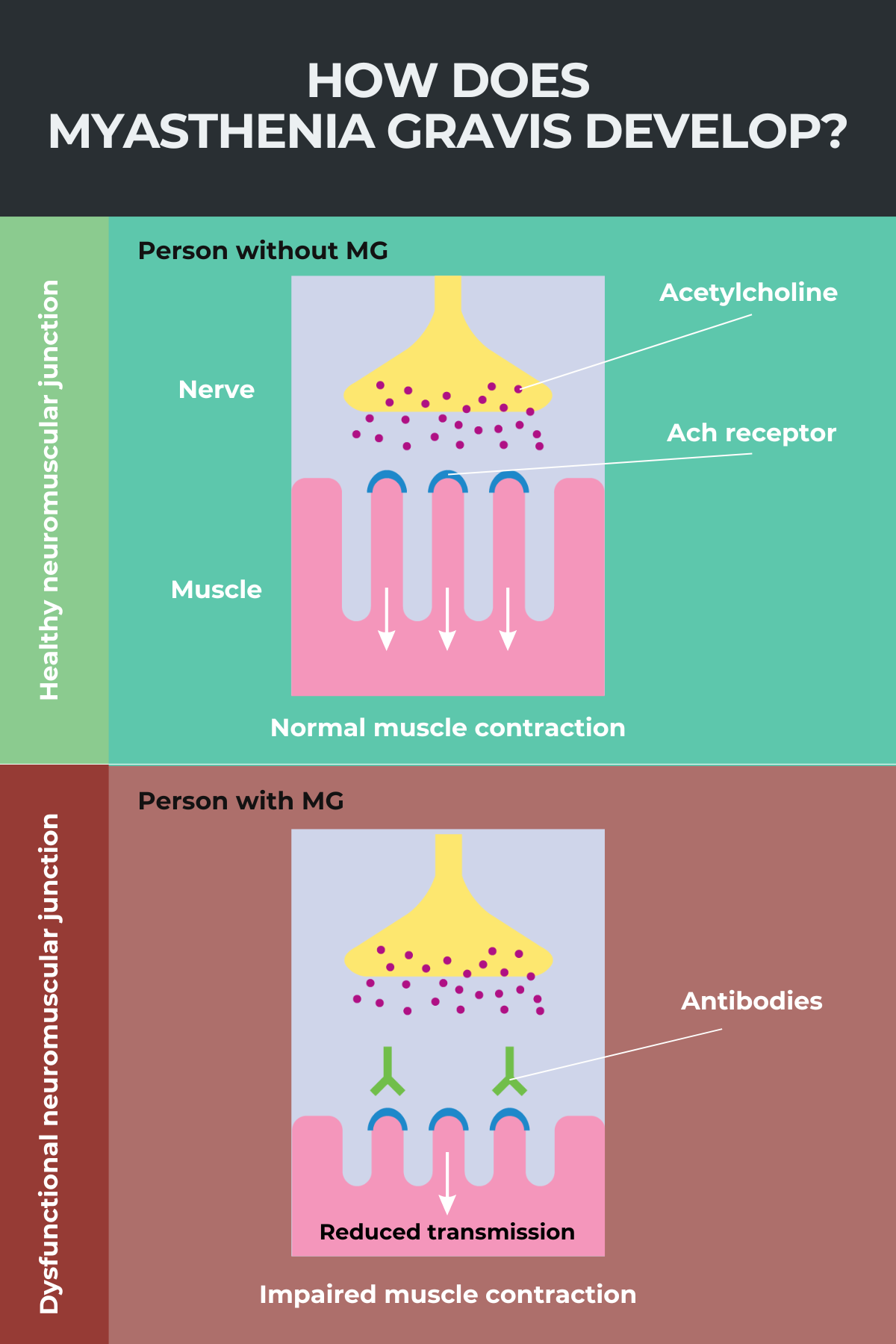 Neuromuscular Junction Myasthenia Gravis 3669