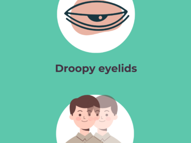Ocular MG symptoms infographic showing droopy eyelids and double vision.