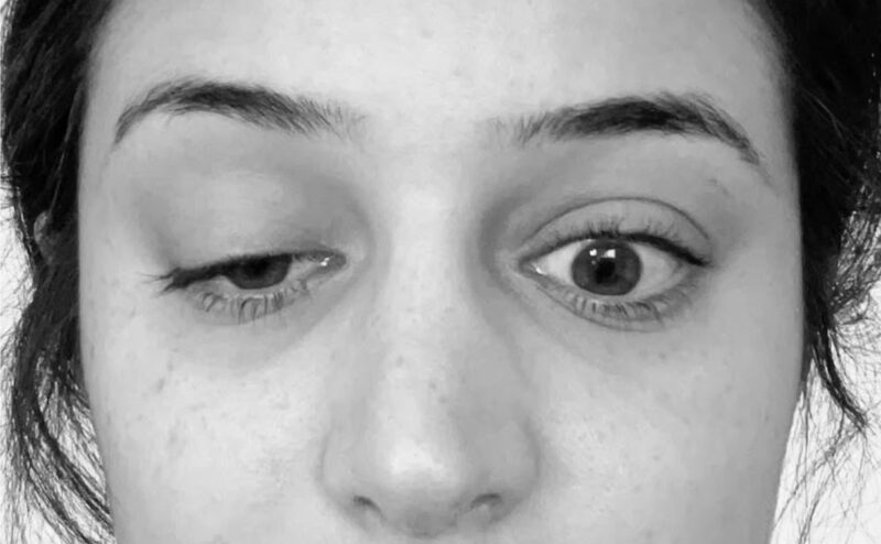 A black-and-white close-up photo of a woman's face, from the bottom of her nose to the middle of her forehead, highlighting that her right eye is droopy.