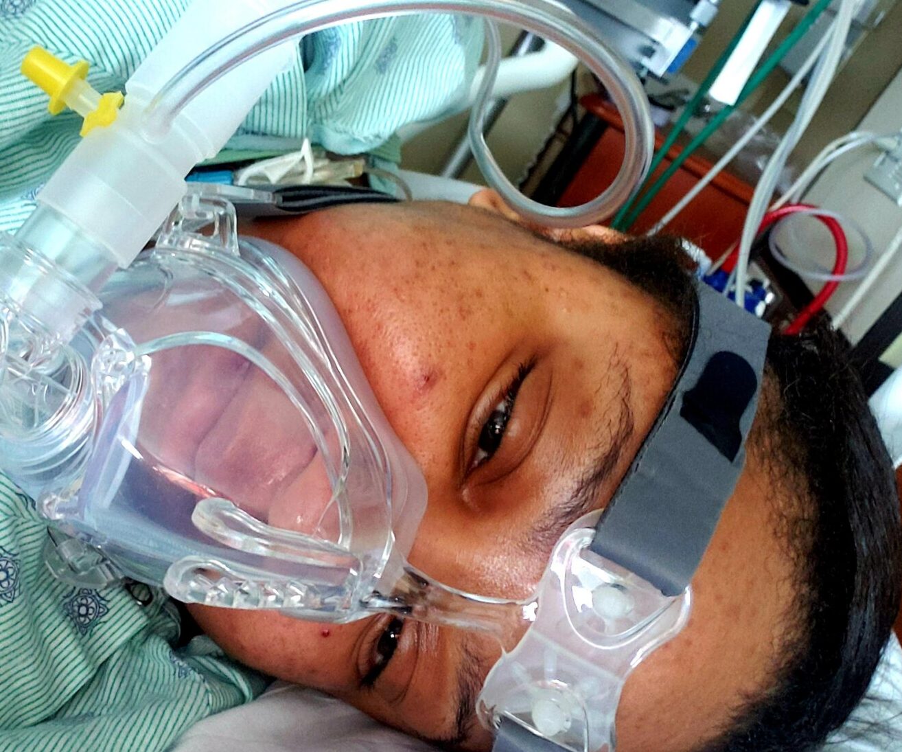A woman lies in a hospital bed with an oxygen mask covering her nose and mouth.
