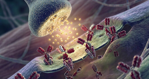 Myasthenia Gravis clinical overview